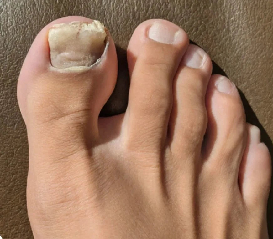 Ongles Épais
