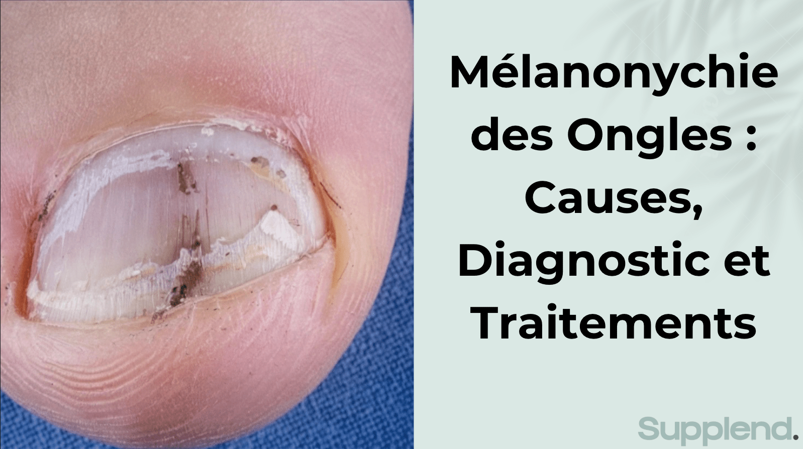 M lanonychie Des Ongles Causes Diagnostic Et Traitements M lanonychie Des Ongles Causes Diagnostic Et Traitements